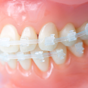 目立たずに矯正がしたい方へ